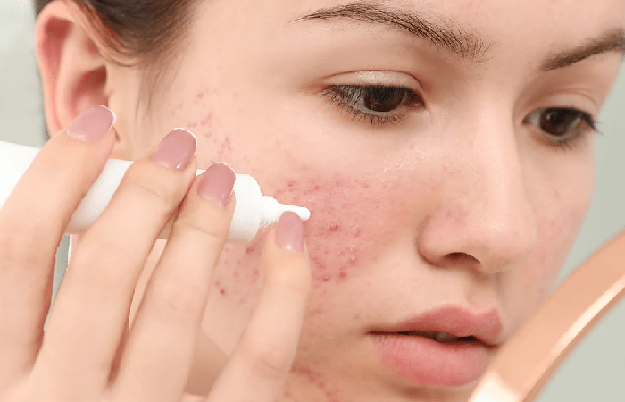 Comprehensive Guide to Tretinoin Strength Chart: Finding the Ideal Concentration for Your Skin